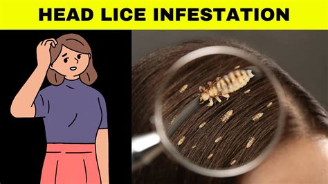 artemide lice|Head lice: Diagnosis and treatment .